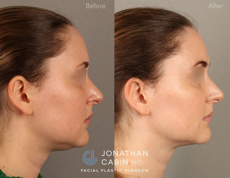 KEHA0219-Lipo-FaceTite-Buccal-Fat_Page_4