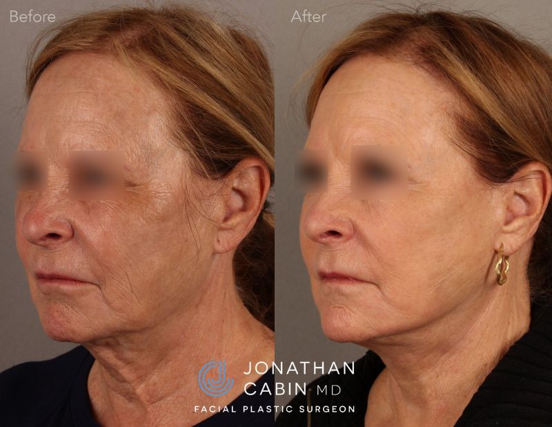 Revision-Facelift-Lower-Bleph-Laser-L-Oblique-Blurred-Jonathan-Cabin-MD